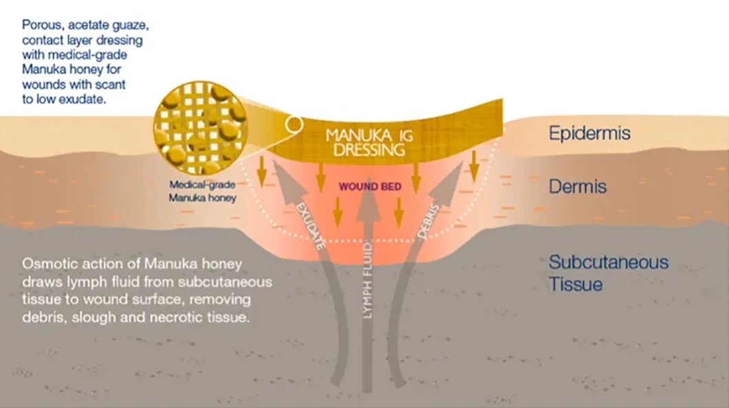 Hot Sale Manuka Honey Medical Gauze Wound Dressing